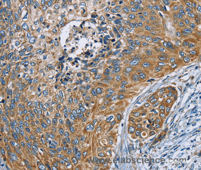 Immunohistochemistry of paraffin-embedded Human cervical cancer tissue using ZMYND11 Polyclonal Antibody at dilution 1:70