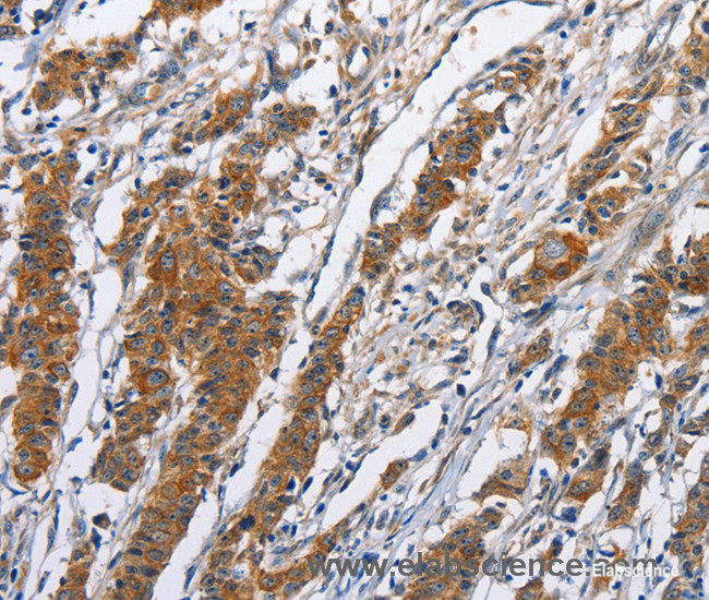 Immunohistochemistry of paraffin-embedded Human gasrtic cancer tissue using NCAPD3 Polyclonal Antibody at dilution 1:50