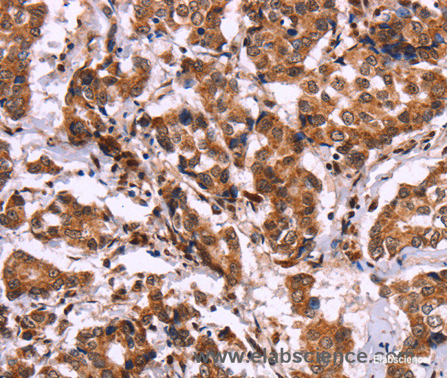 Immunohistochemistry of paraffin-embedded Human breast cancer tissue using CARD11 Polyclonal Antibody at dilution 1:40