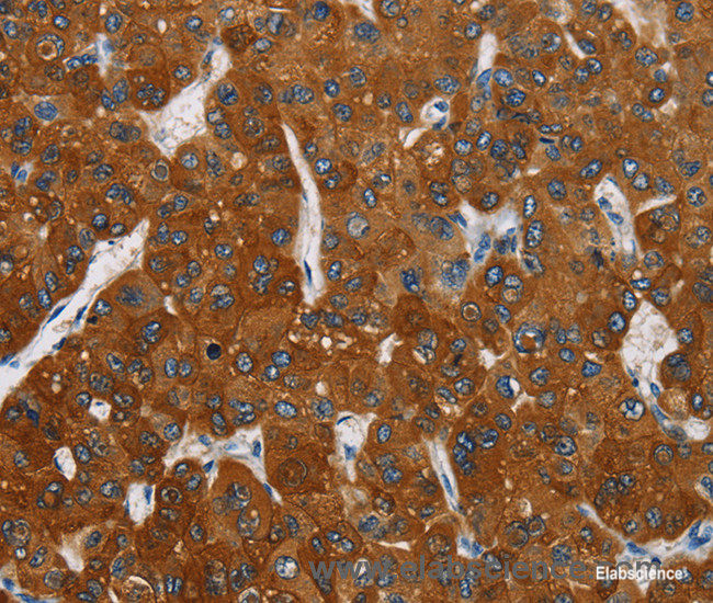 Immunohistochemistry of paraffin-embedded Human liver cancer tissue using CARD9 Polyclonal Antibody at dilution 1:70
