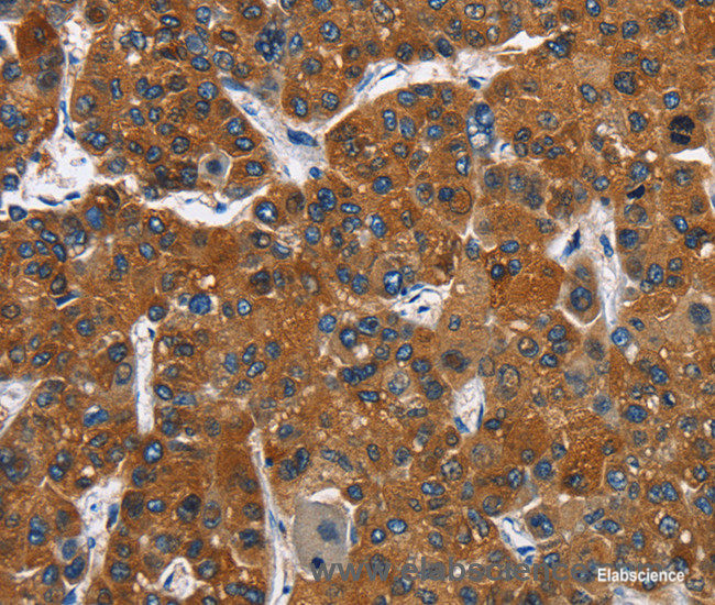 Immunohistochemistry of paraffin-embedded Human liver cancer tissue using CATSPER3 Polyclonal Antibody at dilution 1:60