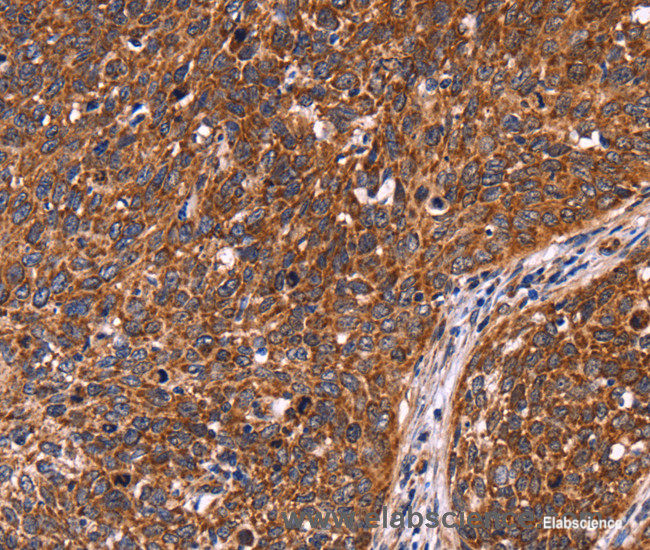 Immunohistochemistry of paraffin-embedded Human cervical cancer tissue using CCDC106 Polyclonal Antibody at dilution 1:60