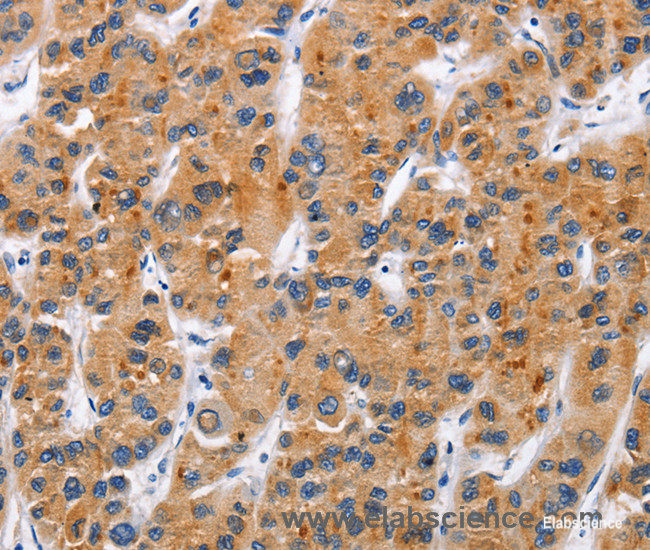 Immunohistochemistry of paraffin-embedded Human liver cancer tissue using CD137 Polyclonal Antibody at dilution 1:50