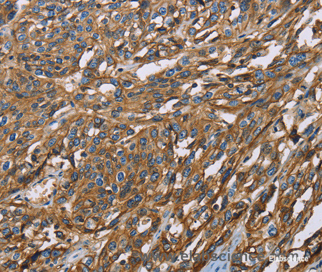 Immunohistochemistry of paraffin-embedded Human esophagus cancer tissue using BSG Polyclonal Antibody at dilution 1:60