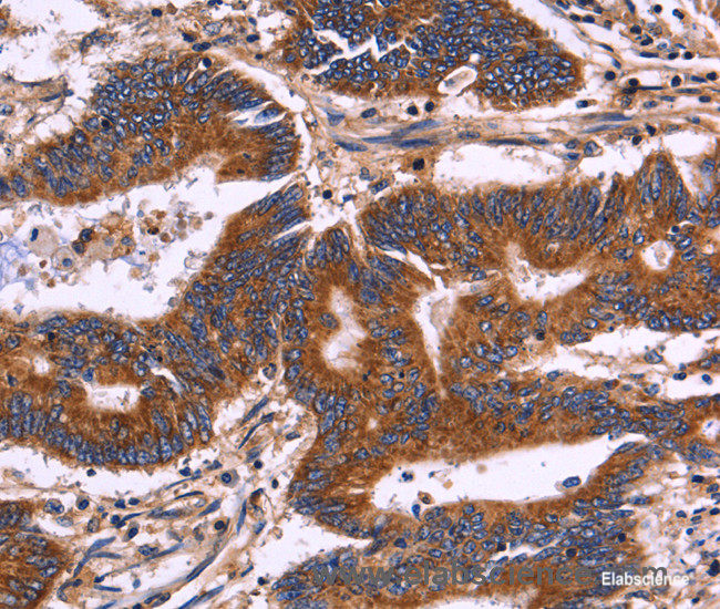 Immunohistochemistry of paraffin-embedded Human colon cancer tissue using KIR2DL1/3/4/S4 Polyclonal Antibody at dilution 1:30