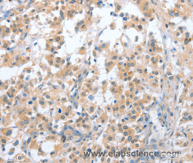 Immunohistochemistry of paraffin-embedded Human thyroid cancer tissue using OX2R Polyclonal Antibody at dilution 1:70