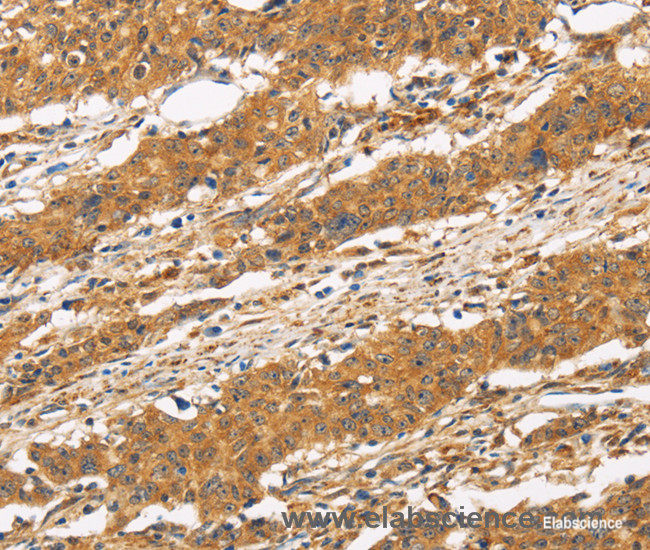 Immunohistochemistry of paraffin-embedded Human gasrtic cancer tissue using CD22 Polyclonal Antibody at dilution 1:50