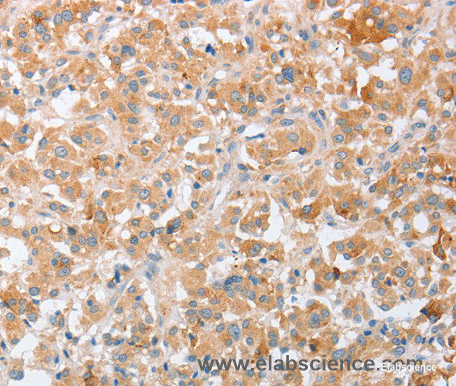 Immunohistochemistry of paraffin-embedded Human thyroid cancer tissue using SIGLEC9 Polyclonal Antibody at dilution 1:40