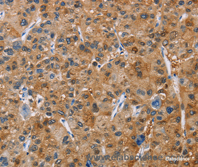 Immunohistochemistry of paraffin-embedded Human liver cancer tissue using NCR3 Polyclonal Antibody at dilution 1:40