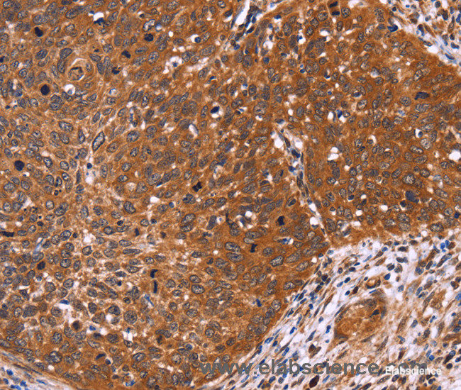 Immunohistochemistry of paraffin-embedded Human cervical cancer tissue using CDC37L1 Polyclonal Antibody at dilution 1:60