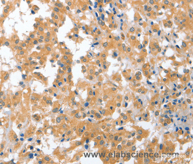 Immunohistochemistry of paraffin-embedded Human thyroid cancer tissue using CDR2 Polyclonal Antibody at dilution 1:60