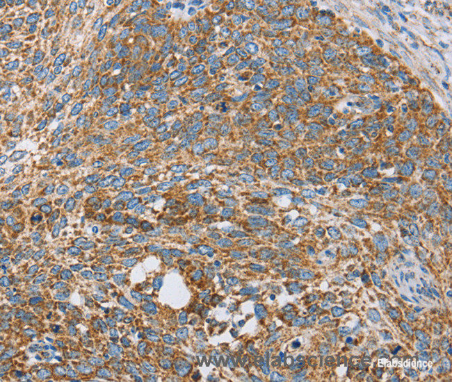 Immunohistochemistry of paraffin-embedded Human cervical cancer tissue using CENPO Polyclonal Antibody at dilution 1:40