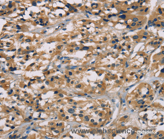 Immunohistochemistry of paraffin-embedded Human thyroid cancer tissue using hCG Polyclonal Antibody at dilution 1:65