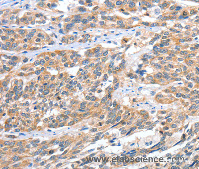 Immunohistochemistry of paraffin-embedded Human esophagus cancer tissue using CGB Polyclonal Antibody at dilution 1:60