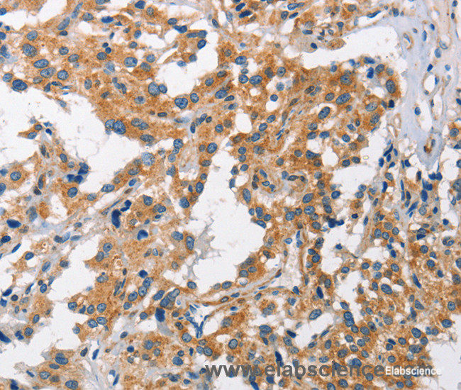 Immunohistochemistry of paraffin-embedded Human thyroid cancer tissue using CHMP1A Polyclonal Antibody at dilution 1:60