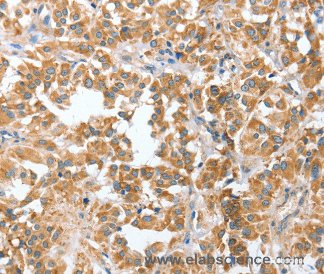 Immunohistochemistry of paraffin-embedded Human thyroid cancer tissue using CIAPIN1 Polyclonal Antibody at dilution 1:60
