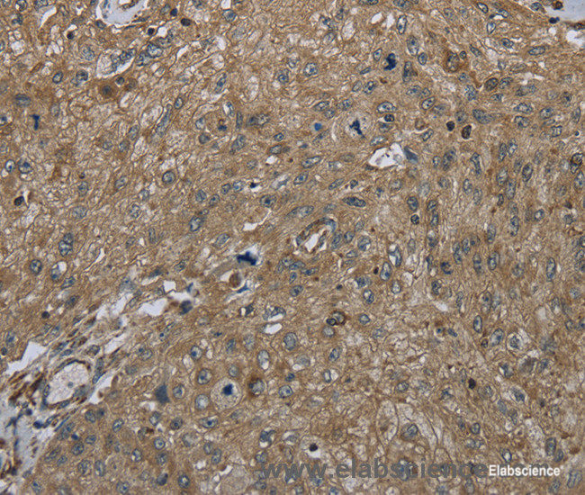 Immunohistochemistry of paraffin-embedded Human esophagus cancer tissue using CLPS Polyclonal Antibody at dilution 1:45