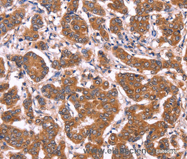 Immunohistochemistry of paraffin-embedded Human breast cancer tissue using COL20A1 Polyclonal Antibody at dilution 1:40