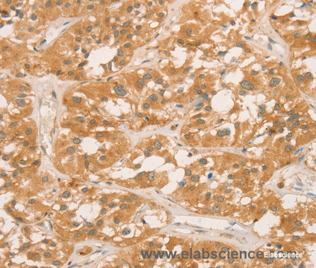 Immunohistochemistry of paraffin-embedded Human thyroid cancer tissue using CPB1 Polyclonal Antibody at dilution of 1:60