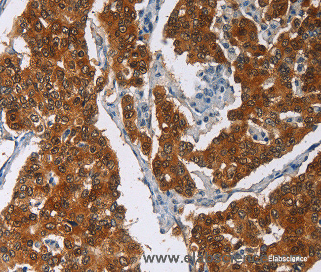 Immunohistochemistry of paraffin-embedded Human breast cancer tissue using CRABP2 Polyclonal Antibody at dilution 1:40
