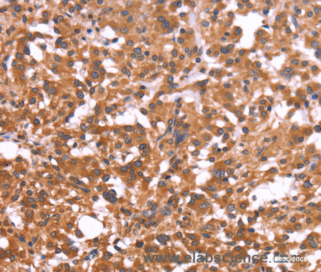 Immunohistochemistry of paraffin-embedded Human thyroid cancer tissue using CRISP3 Polyclonal Antibody at dilution 1:50