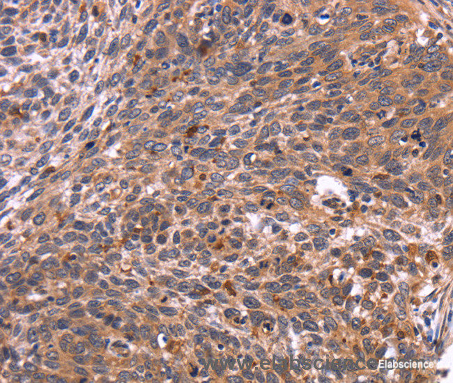 Immunohistochemistry of paraffin-embedded Human cervical cancer tissue using CRK Polyclonal Antibody at dilution 1:40
