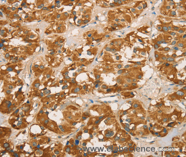 Immunohistochemistry of paraffin-embedded Human thyroid cancer tissue using RBBP8 Polyclonal Antibody at dilution 1:65