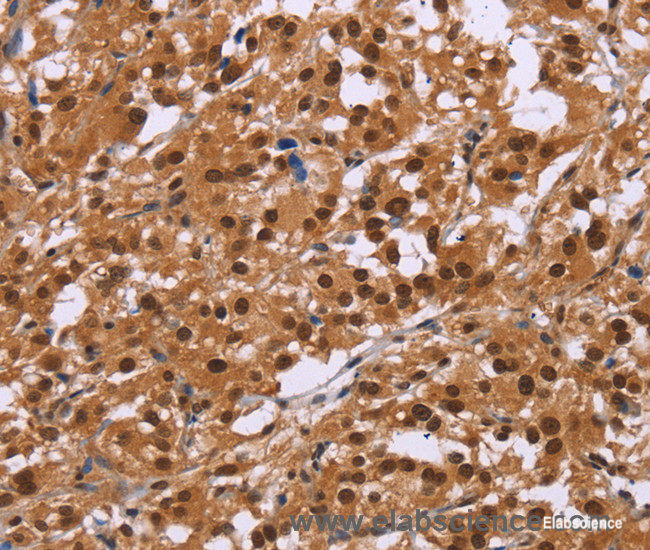 Immunohistochemistry of paraffin-embedded Human thyroid cancer tissue using CTNNBL1 Polyclonal Antibody at dilution 1:50