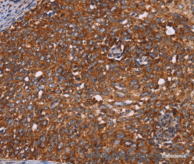 Immunohistochemistry of paraffin-embedded Human cervical cancer tissue using CYP2W1 Polyclonal Antibody at dilution 1:60