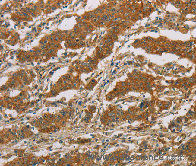 Immunohistochemistry of paraffin-embedded Human gasrtic cancer tissue using CYP39A1 Polyclonal Antibody at dilution 1:50