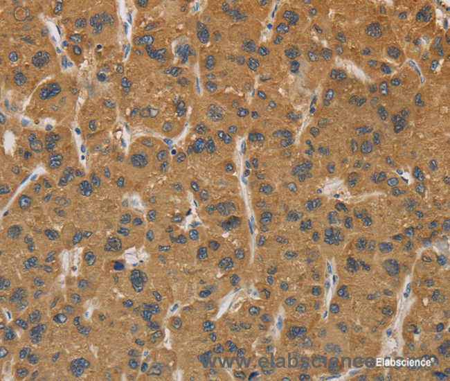 Immunohistochemistry of paraffin-embedded Human liver cancer tissue using CYP17A1 Polyclonal Antibody at dilution 1:30