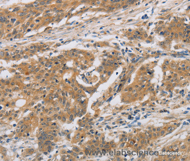 Immunohistochemistry of paraffin-embedded Human ovarian cancer tissue using CST6 Polyclonal Antibody at dilution 1:30