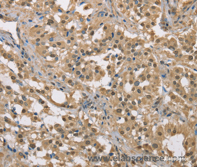 Immunohistochemistry of paraffin-embedded Human thyroid cancer tissue using DACH2 Polyclonal Antibody at dilution 1:40