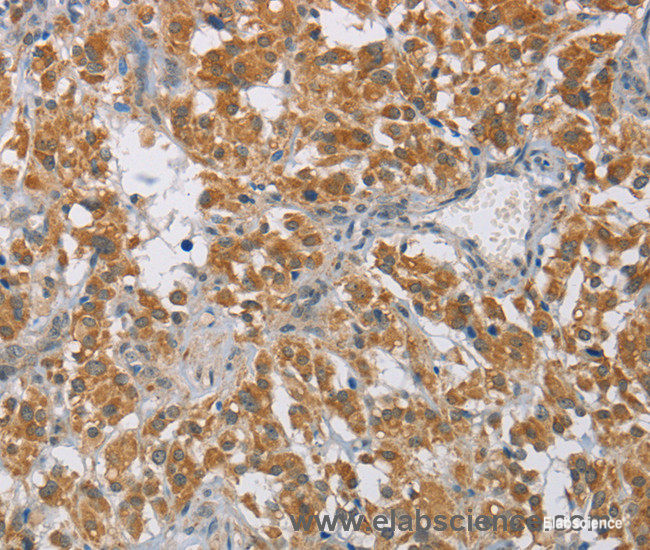 Immunohistochemistry of paraffin-embedded Human thyroid cancer tissue using DIO1 Polyclonal Antibody at dilution 1:60