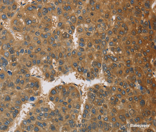 Immunohistochemistry of paraffin-embedded Human liver cancer tissue using TNFRSF10D Polyclonal Antibody at dilution 1:60