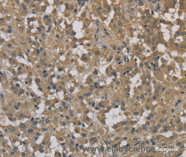 Immunohistochemistry of paraffin-embedded Human thyroid cancer tissue using DCTN3 Polyclonal Antibody at dilution 1:70