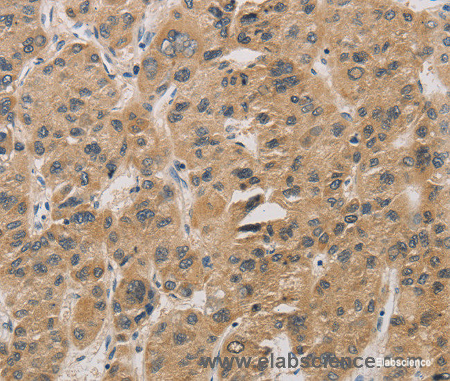 Immunohistochemistry of paraffin-embedded Human liver cancer tissue using DDIT4 Polyclonal Antibody at dilution 1:30