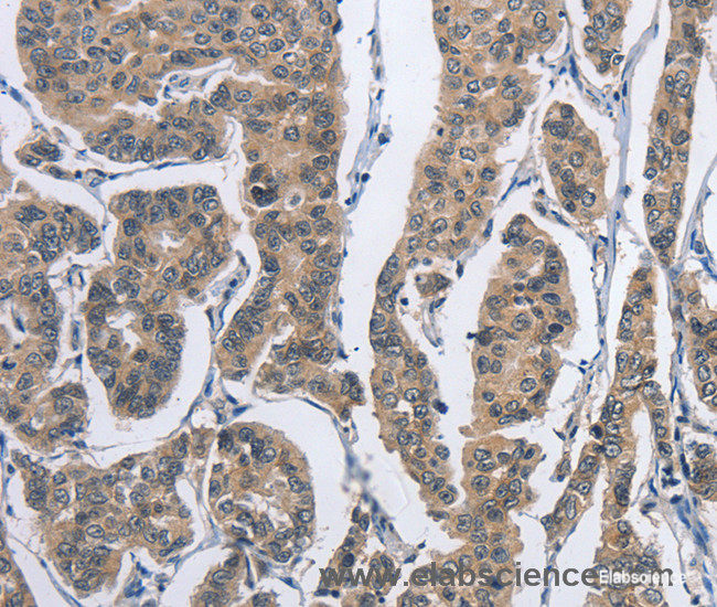 Immunohistochemistry of paraffin-embedded Human breast cancer tissue using DSG2 Polyclonal Antibody at dilution 1:50