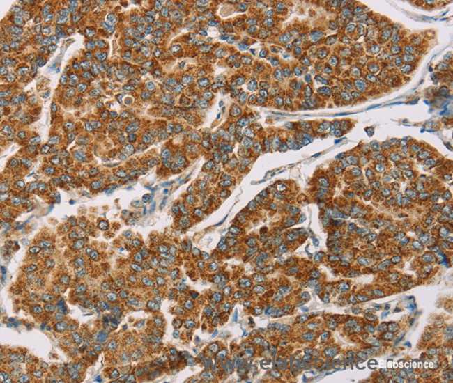 Immunohistochemistry of paraffin-embedded Human breast cancer tissue using DLL4 Polyclonal Antibody at dilution 1:40