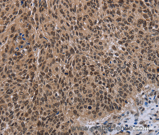 Immunohistochemistry of paraffin-embedded Human lung cancer tissue using DLX4 Polyclonal Antibody at dilution 1:50