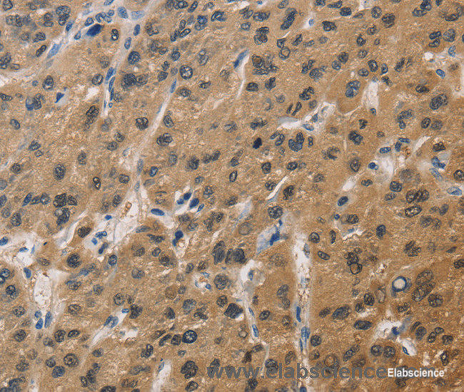 Immunohistochemistry of paraffin-embedded Human liver cancer tissue using DUSP26 Polyclonal Antibody at dilution 1:60