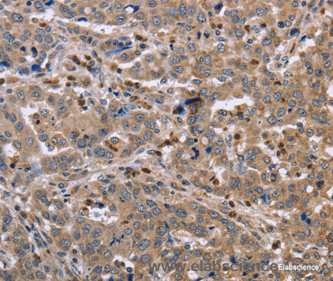 Immunohistochemistry of paraffin-embedded Human liver cancer tissue using EDA Polyclonal Antibody at dilution 1:30