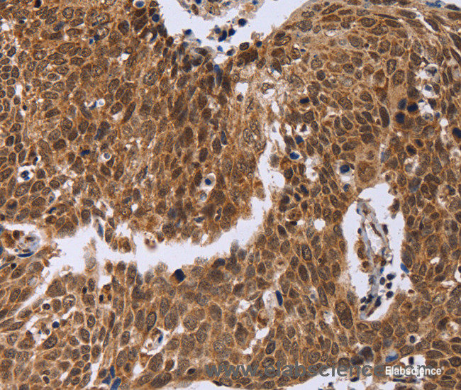 Immunohistochemistry of paraffin-embedded Human cervical cancer tissue using ERCC6L Polyclonal Antibody at dilution 1:30