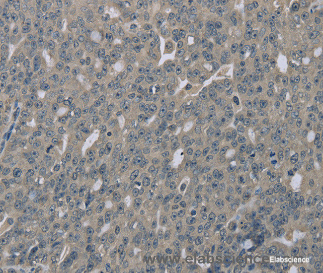 Immunohistochemistry of paraffin-embedded Human ovarian cancer tissue using EDN1 Polyclonal Antibody at dilution 1:30