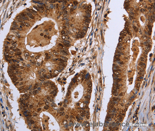 Immunohistochemistry of paraffin-embedded Human colon cancer tissue using EXTL3 Polyclonal Antibody at dilution 1:30