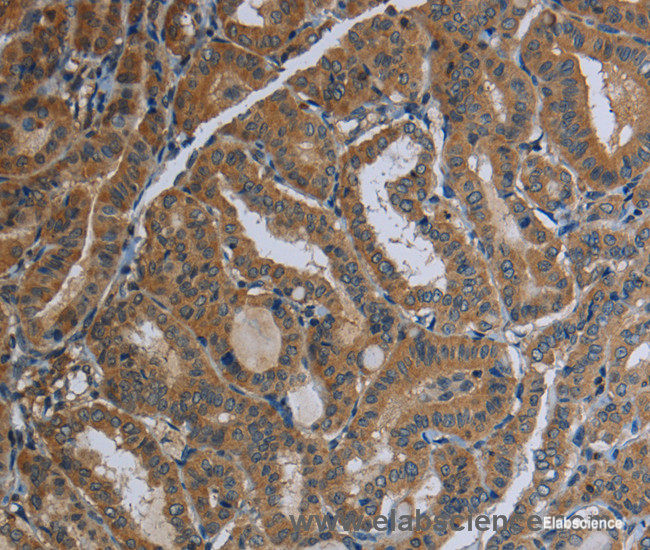 Immunohistochemistry of paraffin-embedded Human thyroid cancer tissue using FAAH Polyclonal Antibody at dilution 1:40