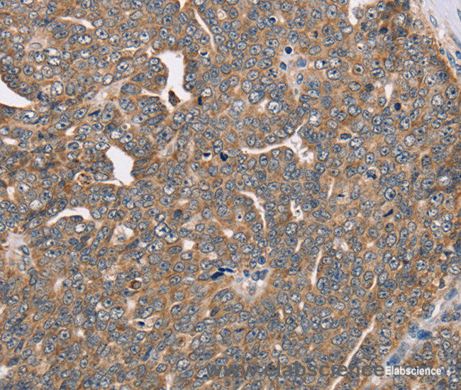Immunohistochemistry of paraffin-embedded Human cervical cancer tissue using FAIM2 Polyclonal Antibody at dilution 1:40