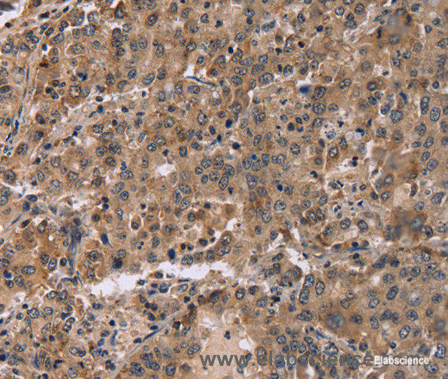Immunohistochemistry of paraffin-embedded Human liver cancer tissue using FAM107A Polyclonal Antibody at dilution 1:30