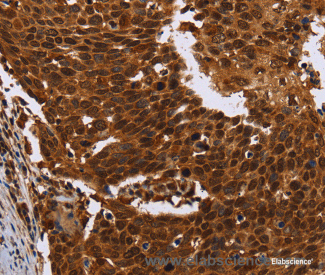 Immunohistochemistry of paraffin-embedded Human cervical cancer tissue using FANCF Polyclonal Antibody at dilution 1:60