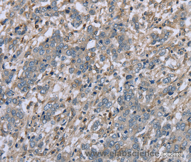 Immunohistochemistry of paraffin-embedded Human liver cancer tissue using FAP Polyclonal Antibody at dilution 1:30